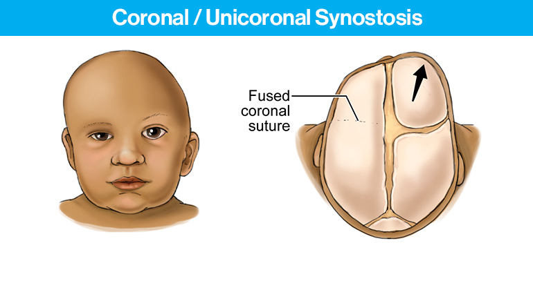 Cranial Disorders and Head Shape | Mount Sinai - New York